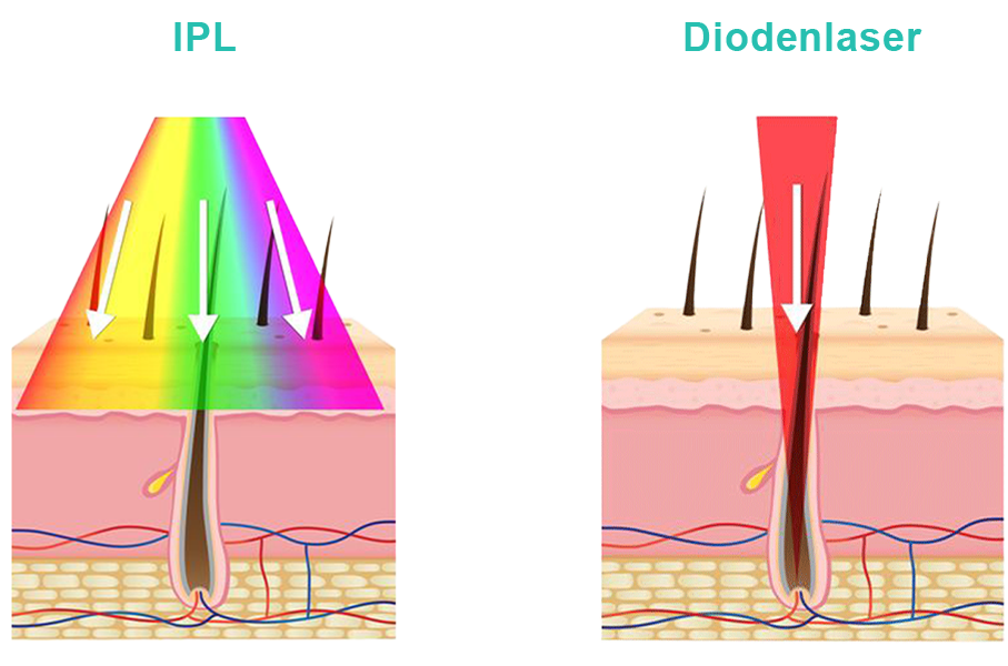 Diodenlaser vs IPL Laser, Was wirkt besser?, Dauerhafte Haarentfernung Essen